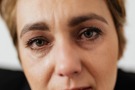 dark circles round eyes